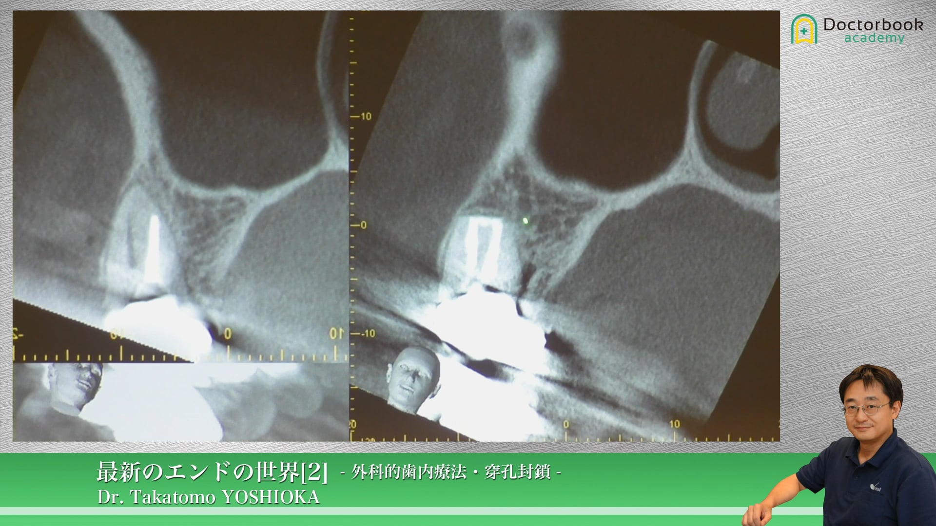 逆根管窩洞形成 #2