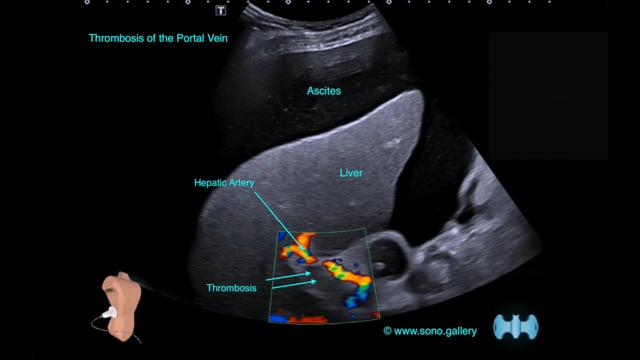 Thrombosis of the Portal Vein, Ascites