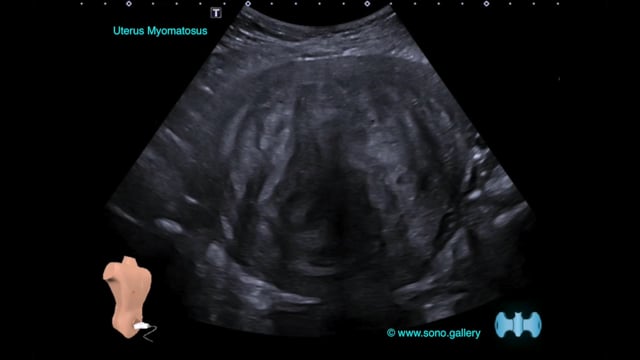 Uterus Myomatosus