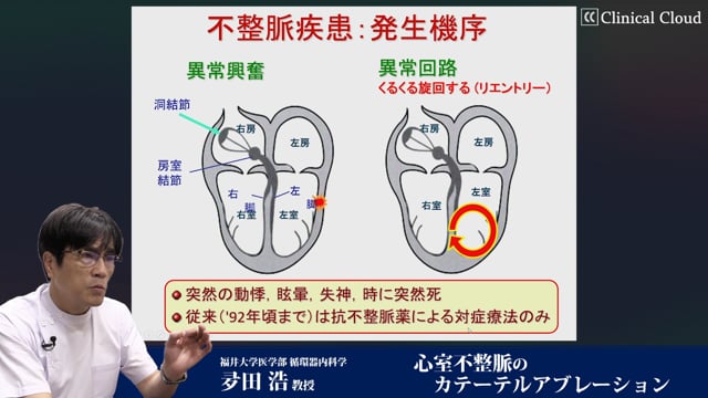 心室不整脈のカテーテルアブレーション