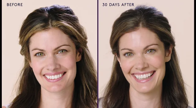 Botox Before and After Results - Everything You Need to See & Know