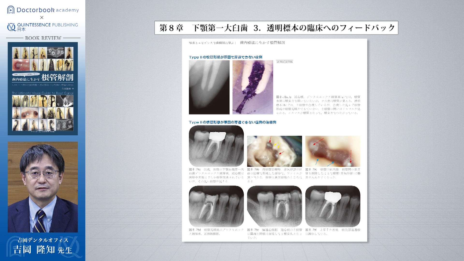 【Book Rev.】歯内療法に生かす根管解剖