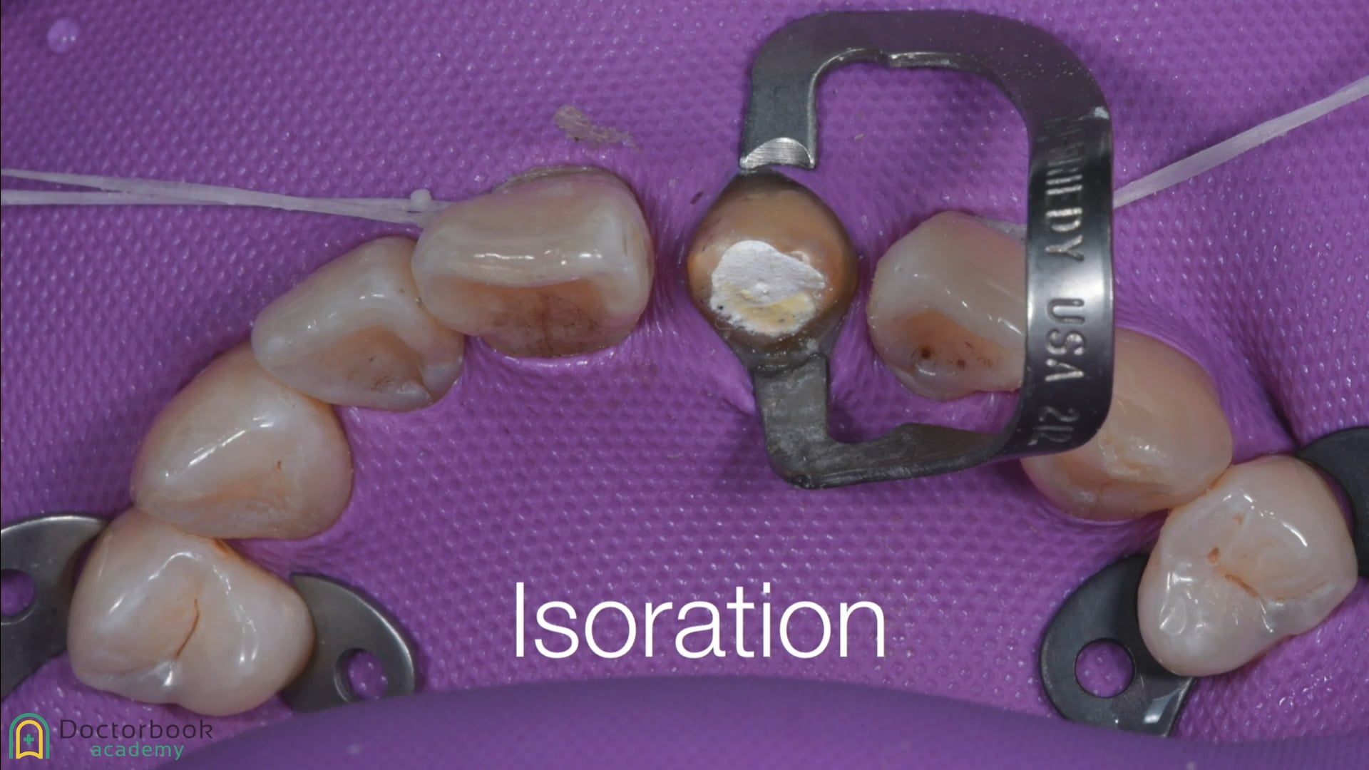 #5 ラバーダムの装着法と前歯部治療の症例