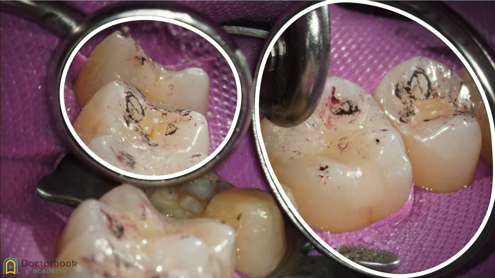 #6 臼歯部のラバーダムのテクニックと前歯部ドロップコーンテクニック