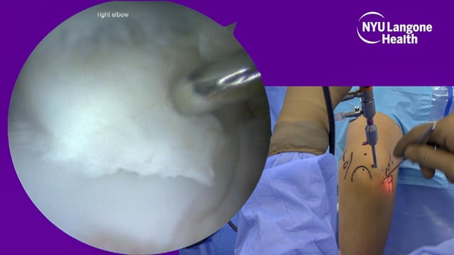 Arthroscopic Debridement and Microfracture of Osteochondritis Dissecans of the Capitellum