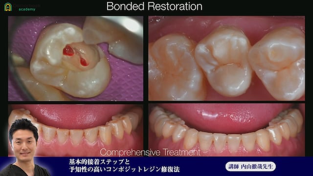 #1 Bonded Restoration、接着について、マイクロを使用する利点