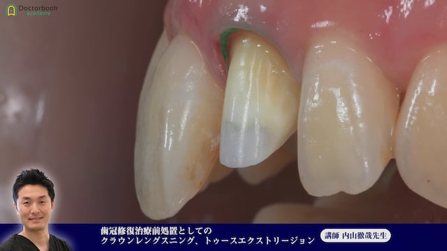 #1 Dentogingival Complexを理解する