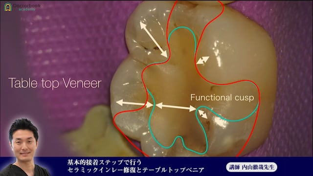 ⑥基本的接着ステップで行うセラミックインレー修復とテーブルトップベニア