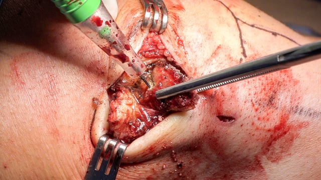 Bipartite Patella Fragment Excision