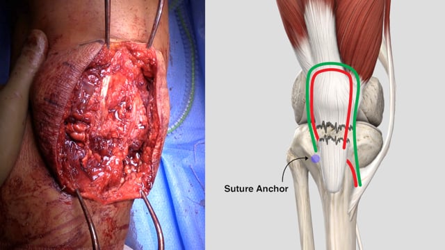 patellar tendon rupture