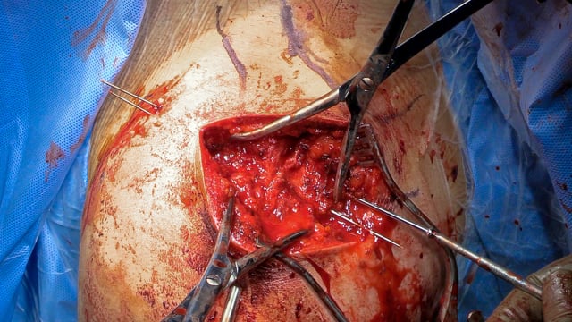 Surgical Management of Os Acromiale Internal Fixation using Cannulated Screws and Tension Band Wiring