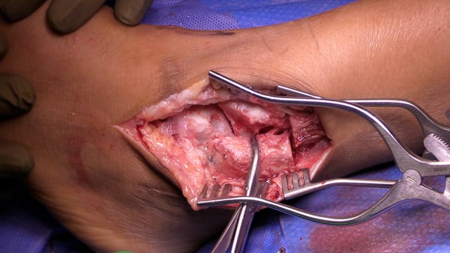 Lateral Talar Dome Osteochondral Allograft Transplantation via Fibular Osteotomy – Topic Overview and Surgical Technique