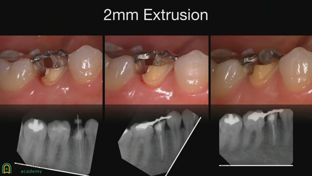 #5 Tooth Extrusion 