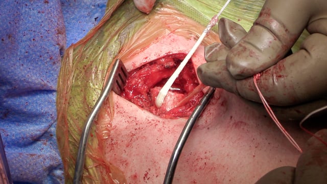 Sternoclavicular Joint Reconstruction Hamstring Autograft Reconstruction of an Irreducible Anterior Dislocation