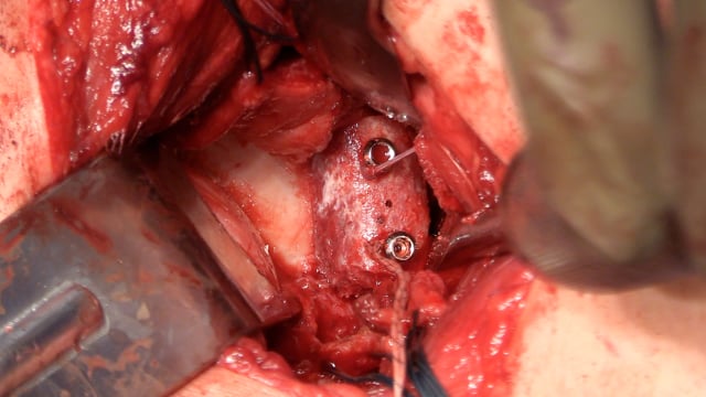 Surgical Management of Traumatic Anterior Shoulder Instability with a Tricortical Cryopreserved Iliac Crest Allograft