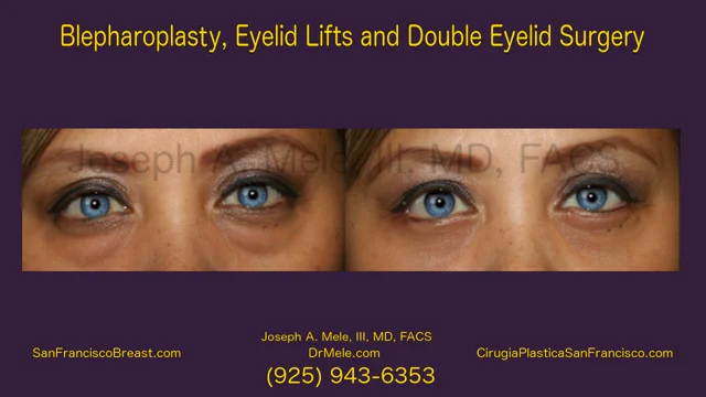 Double eyelid surgery bay hot sale area