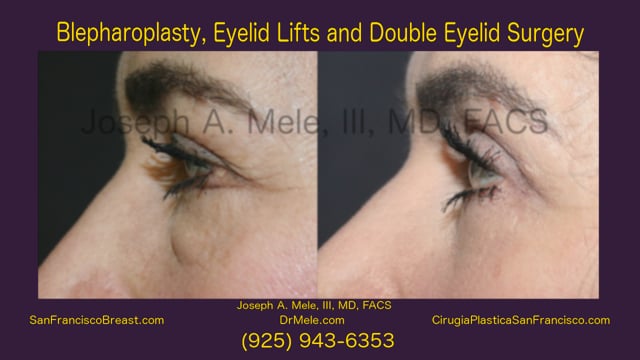 Double eyelid shop surgery bay area