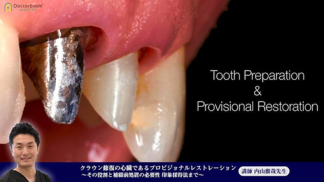 #1 Tooth Preparationの条件