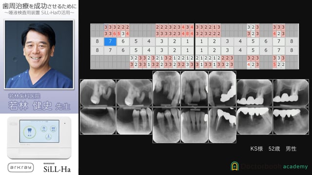 唾液検査装置SiLL-Ha 歯周治療を成功させるために