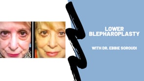 Lower Blepharoplasty Procedure with Dr. Soroudi