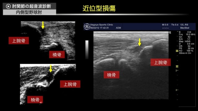 肘関節の超音波診断 1 内 外側側副靭帯編 Clinical Cloud By Medipal