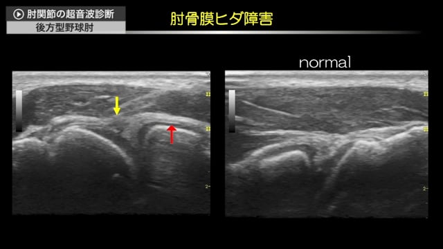 肘関節の超音波診断_5：後方型野球肘 編