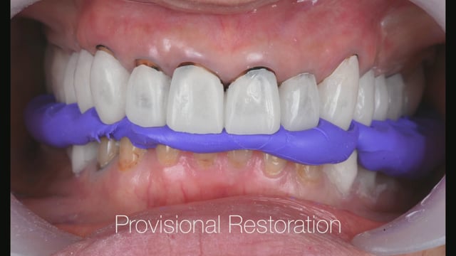 ⑪多数歯補綴における、最終修復物を見据えたプロビジョナルレスト 