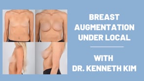 Breast Augmentation Under Local with Dr. Kenneth Kim