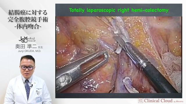 結腸癌に対する完全腹腔鏡手術-体内吻合-