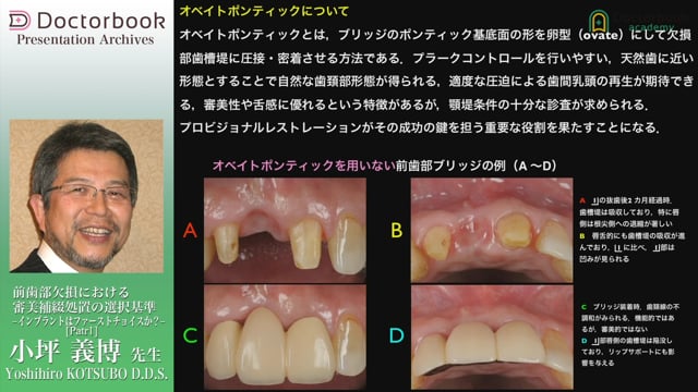 前歯部欠損における審美補綴処置の選択基準 -インプラントは 