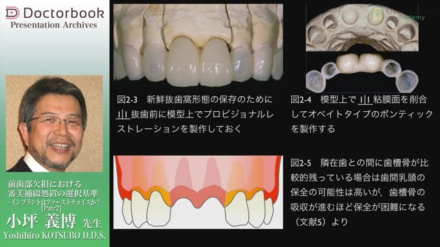 前歯部欠損における審美補綴処置の選択基準 -インプラントは 