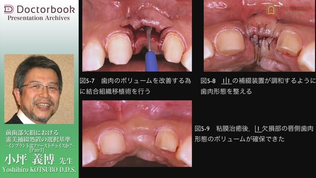 ネット限定】 【裁断】前歯部審美修復 インプラント編 健康・医学 