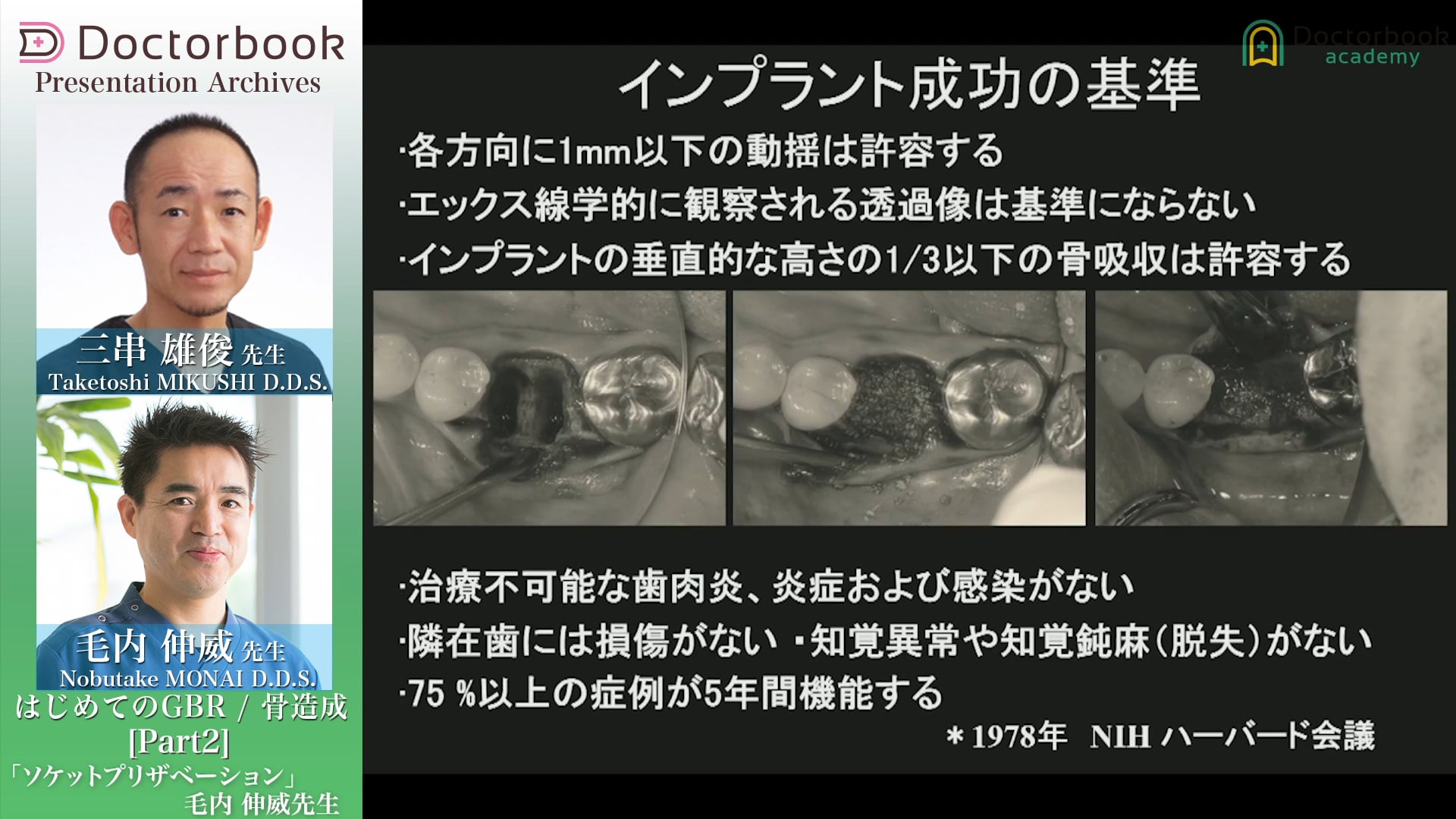 #2 インプラント成功の基準