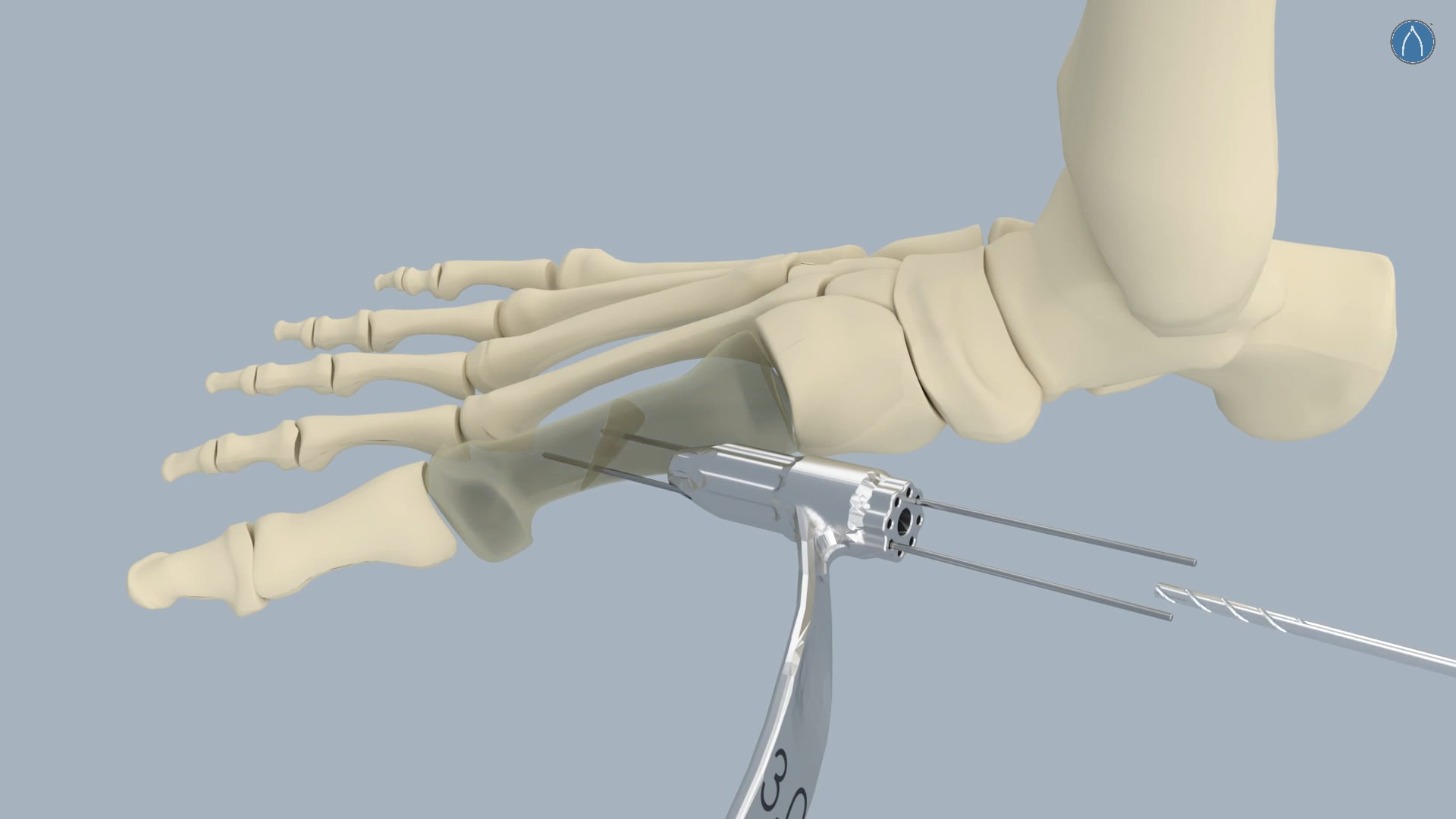 AlloMate Bone Pin System on Vimeo