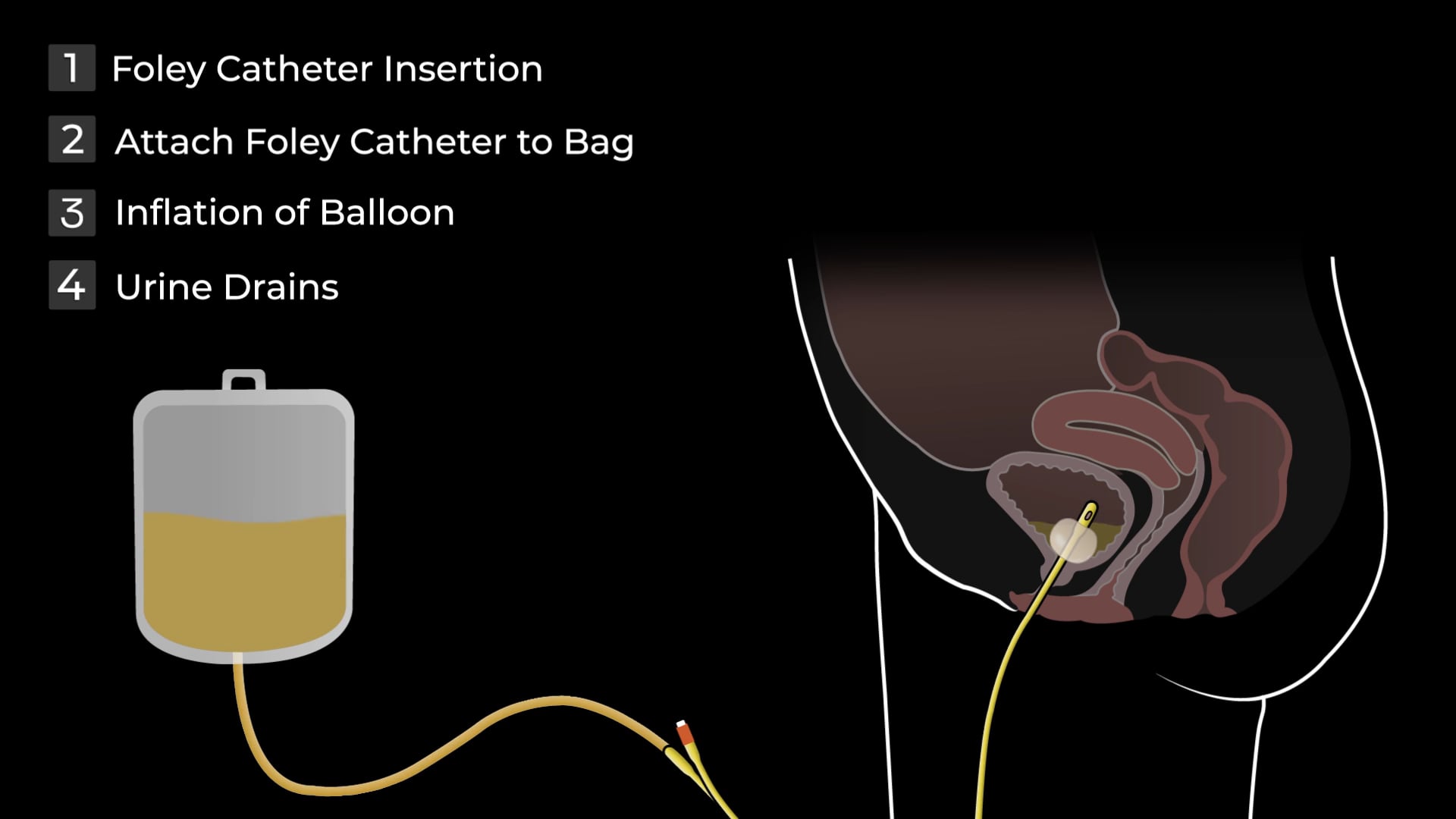 02689 - Female Foley Catheter Insertion_V001 on Vimeo