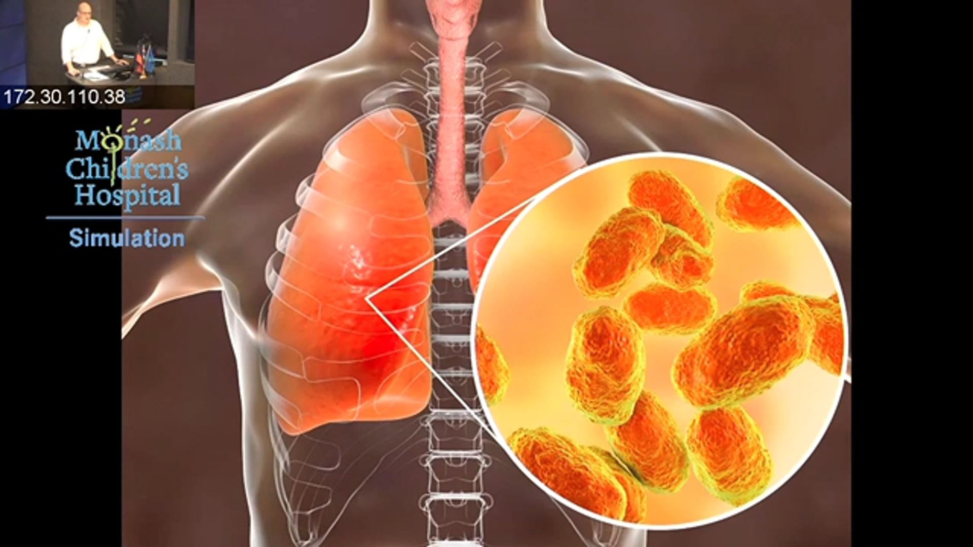 Cystic Fibrosis