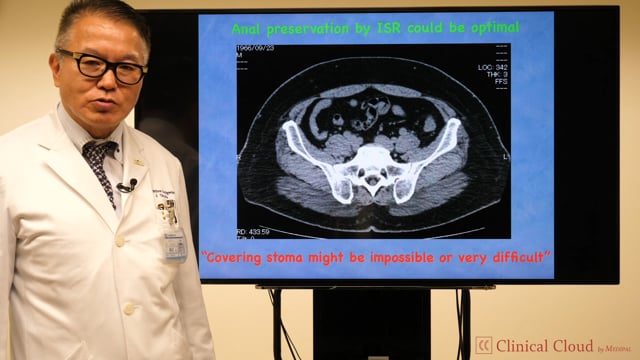 Cutting Edge of MIS for Rectal Cancer -Part2-