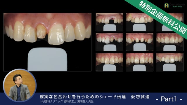 確実な色合わせを行うためのシェード伝達 仮想試適