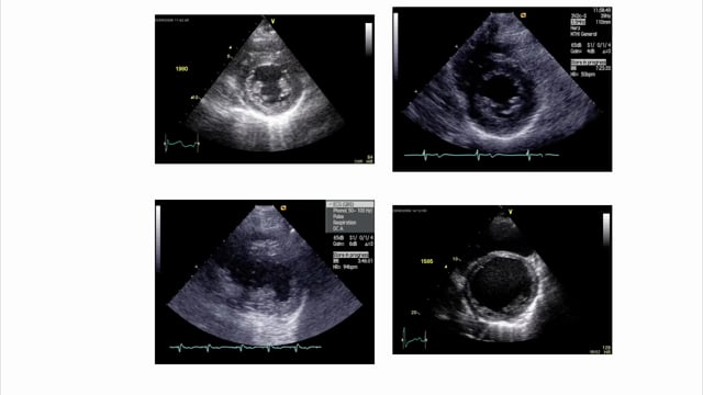 How can I eyeball LVF?