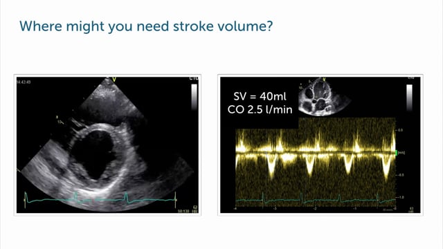 In which patients should I calculate SV?