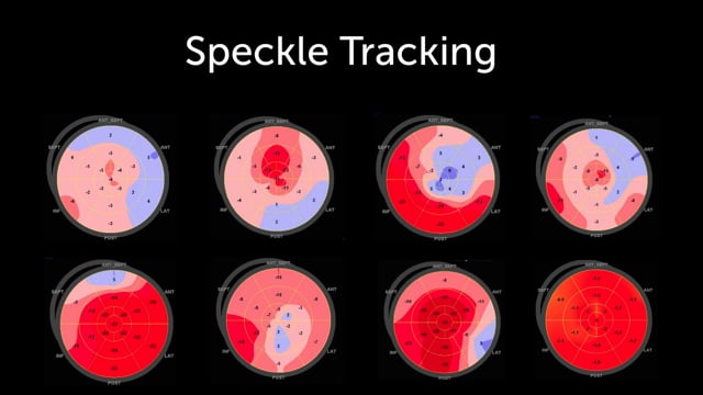 What is speckle tracking?