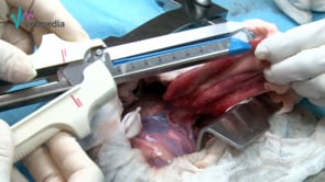 Lobectomía pulmonar completa con grapadora automática (grapadora LC)