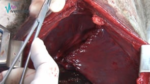 Resolución de hernia diafragmática radial y desinserción diafragmática o hernia circunferencial