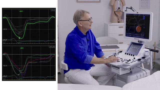 How do I assess the results of speckle tracking?