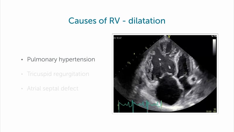 What are causes for RV dilatation?