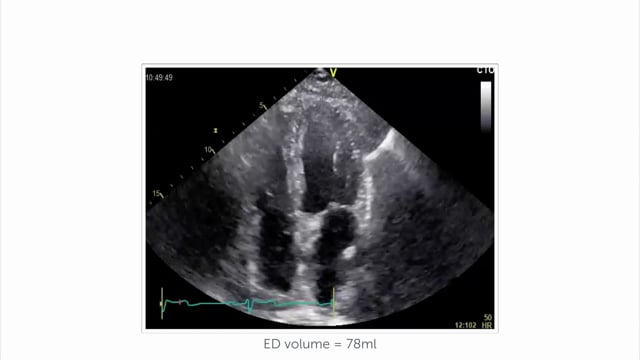 What is the pathoyphysiology of LVH?