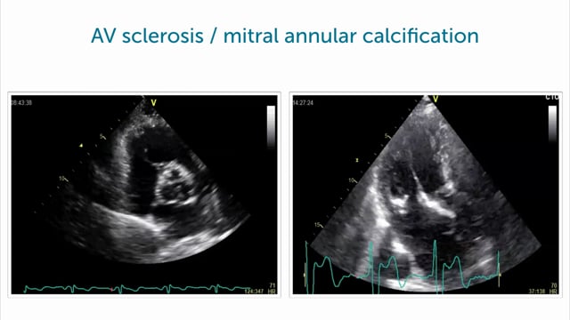 What findings can I see in hypertensive heart desease?