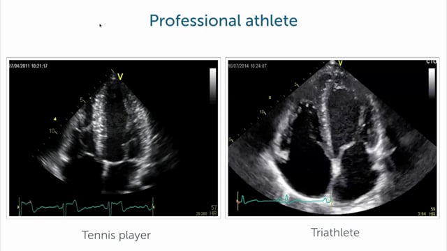 How does the echo change in an athlete?