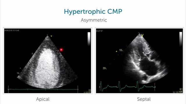 How do I spot hypertrophic CMP?