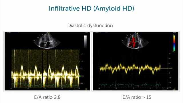 What is infiltrative heart disease?